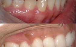 正畸之后去了外地