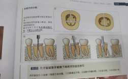 前牙拔除的正确方法有哪些操作要点？