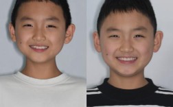 正畸中如何根据面部生长型制定干预策略？