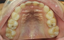 正畸为何刺激口腔黏膜？如何缓解不适？