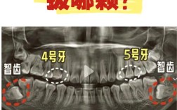 没有智齿还少颗牙，正畸方案怎么定？
