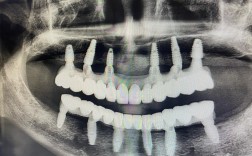 牙槽骨骨量不足，种植牙还有成功的机会吗？