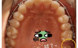 正畸拔需要一颗下牙