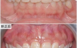 第二前磨牙阻生做正畸