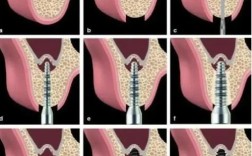 种植牙植骨疼不疼？手术过程和术后疼痛情况如何？