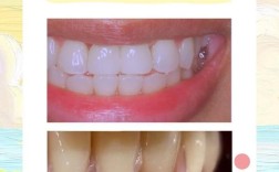 冠延长和种牙哪个更适合自己？从适用情况、优缺点到长期效果该如何科学选择？