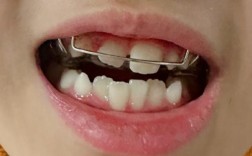 正畸6毫米明显吗