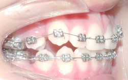 自锁托槽矫正图片能直观看到牙齿变化吗？