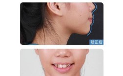 牙齿正畸能矫正侧牙不齐吗？