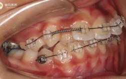 正畸中推簧的作用