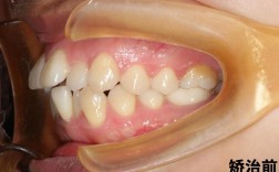 正畸上唇系带低厚