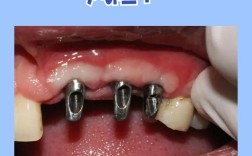 上排大牙种牙图片能展示哪些关键种植效果？