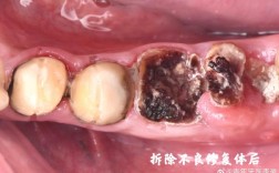 种牙牙冠为什么会掉出来？是什么原因导致的？该怎么办？