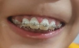 小孩牙齿稀疏该矫正吗？最佳矫正时机是什么时候？