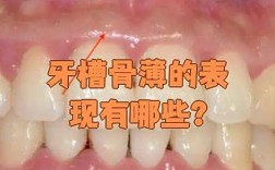 牙槽骨薄正畸植骨