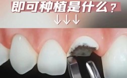 拔牙即刻种植 牙 青岛