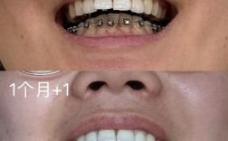 牙齿矫正钢丝脱离是什么原因？如何正确处理？