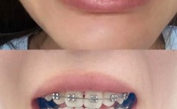 正畸矫正后牙齿易掉