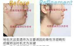 自己矫正偏颌，有哪些安全可行的方法？