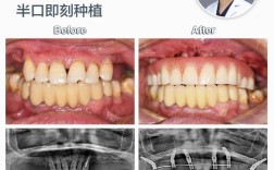 名人 植牙