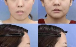 正颌正畸手术前后对比