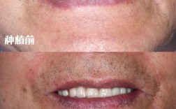 种牙后悔的真实案例，后悔的原因究竟有哪些？