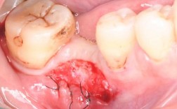 牙槽骨植骨粉手术