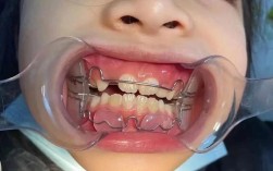 儿童牙齿反颌矫正器