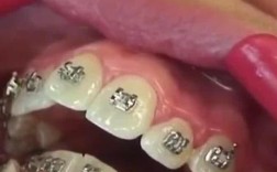 矫正完的牙齿松动