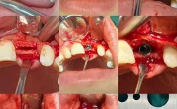 种牙拆完线后为何还需植骨？植骨的必要性、时间安排及术后恢复注意事项有哪些？