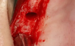 上颌窦囊肿手术后植牙