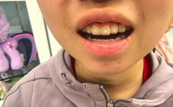 正畸四周复诊一次