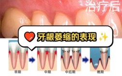 牙周炎患者可以做种植牙吗？术前需要将炎症控制到什么程度才能确保手术成功和种植体长期稳定？