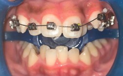 正畸托槽粘结过程的关键步骤和注意事项有哪些？