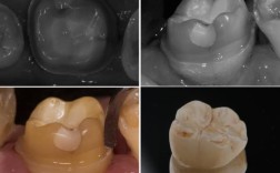 黄叶君前牙的预备方法