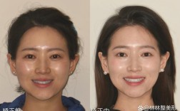 正畸后牙前移脸凹