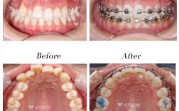 不想正颌手术正畸，不手术矫正可行吗？