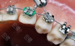 口腔正畸悬吊结扎法图解，操作步骤有哪些？与传统结扎法相比优势在哪？适用哪些错颌畸形病例？