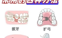 缺牙正畸关闭间隙，图解详解如何实现？