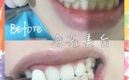 冷光美白的方法有哪些？具体步骤是怎样的？