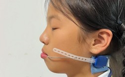 重度骨性后缩正畸