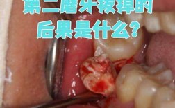 第二前磨牙烂了正畸