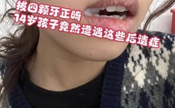 牙齿矫正拔四颗牙