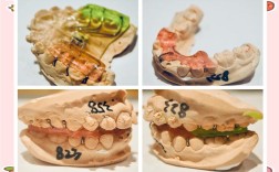 MBT直丝弓隐形正畸适合哪些牙齿问题矫正？