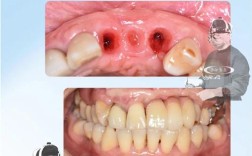 种牙失败的表现