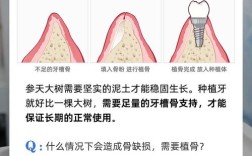 牙植体可以放在牙骨里吗