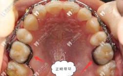 如何科学选择正畸带环的合适大小？