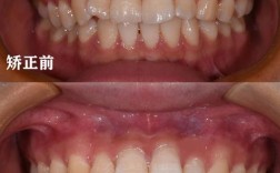 牙齿太稀矫正后，照片能看出牙齿变密吗？