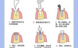 下半植牙如何固定