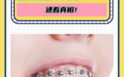 美国孩子牙齿正畸，是普遍现象还是少数选择？